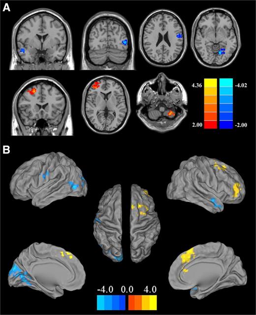 Figure 2. Significant differences in the functional connectivity of PCC between type 2 diabetic patients and healthy controls. (A) Abnormal functional connectivity of PCC in selected brain regions. (B) Three-dimensional views of abnormal brain regions. Thresholds were set at a corrected P < 0.05, determined by Monte Carlo simulation. Note that the left side corresponds to the right hemisphere.