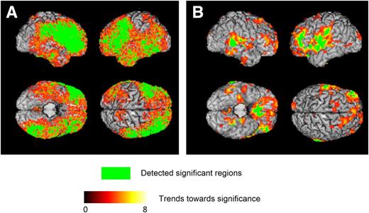 Figure 1. Three-dimensional surface renderings of ODVBA results. A: GM RAVENS maps in relationship with short vs. long diabetes duration at baseline. Subjects with long diabetes duration (n = 100) had lower RAVENS values (i.e., lower regional GM volume, in the highlighted areas) compared with subjects with short diabetes duration (n = 100). B: GM dRAVENS maps in relationship with standard vs. intensive glycemic treatment arm. Subjects in the intensive treatment arm (n = 221) had lower longitudinal decrease in GM tissue volume in the highlighted areas compared with subjects in the standard treatment arm (n = 267). The green color indicates the detected significant regions with FDR-corrected q < 0.05. The hot color indicates the trends toward significance characterized by the −log (P) values shown in the color bar.