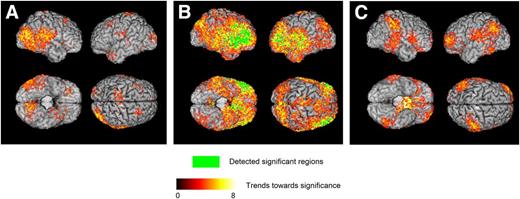 Figure 2. Three-dimensional surface renderings of ODVBA results for longitudinal change in cognitive test scores. Group differences on GM dRAVENS maps between the group with declining cognition (n = 100) vs. nondeclining cognition (n = 100) are shown for DSST (A), RAVLT (B), and STROOP (C) tests. For each three tests, subjects in the group with declining cognition had a higher longitudinal decrease in GM volume in the highlighted areas compared with subjects in the group with nondeclining cognition. The green color indicates the detected significant regions with FDR-corrected q < 0.05. The hot color indicates the trends toward significance characterized by the −log (P) values shown in the color bar.
