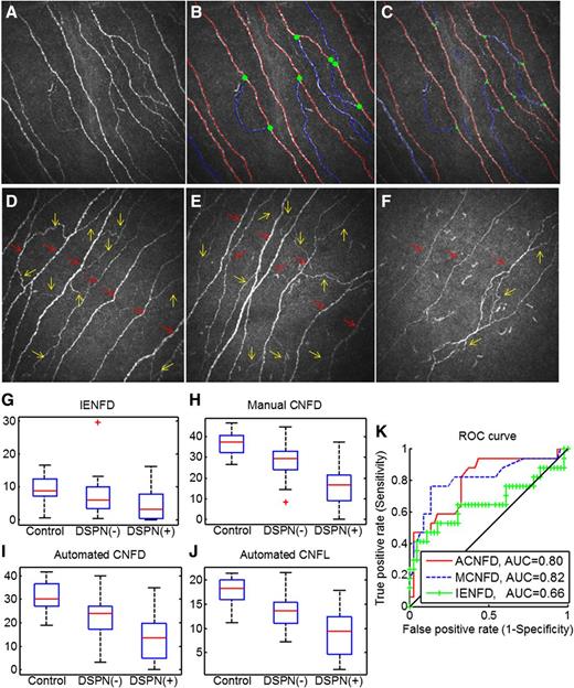 Figure 1. A: Original CCM image. B: Manually quantified CCM image. C: Automatically quantified CCM image. The red lines represent main nerve fibers, blue lines are branches, and green spots indicate branch points on the main nerve trunks. CCM images of the subbasal nerve plexus from a control subject (D), a DSPN(−) patient with type 1 diabetes (E), and a DSPN(+) patient with type 1 diabetes (F) show the reduction in corneal nerves in the DSPN(+) patient. The red arrows indicate main nerve fibers (to calculate CNFD), and yellow arrows indicate branch fibers (to calculate CNBD). Box plots of IENFD (G), manual CNFD values (H), automated CNFD (I), and automated CNFL (J) values in controls and in DSPN(−) and DSPN(+) patients with type 1 diabetes based on the TC. K: ROC curves for manual CNFD (MCNFD), automated CNFD (ACNFD), and IENFD to discriminate DSPN(+) and DSPN(−) patients with diabetes. G–J: Red lines represent median, the box borders 25th and 75th percentile. Whiskers represent the range of the data (without outliers). Red plus symbols represent outliers.