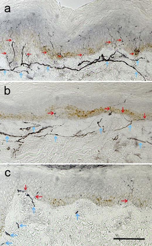 Figure 2. Skin biopsy specimens immunostained for neuronal marker PGP 9.5 from a healthy subject (A), a DSPN(−) patient with type 1 diabetes (B), and a DSPN(+) patient with type 1 diabetes (C). Note the depletion of IENFD (red arrows) and reduction of subepidermal nerve plexus (blue arrows) in B and C, with both features more severe in the DSPN(+) patient (C). Original magnification ×200, scale bar = 100 µm.