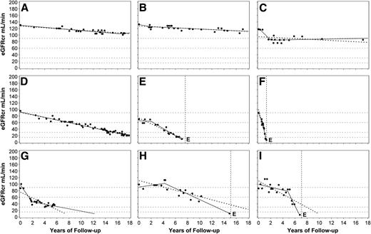 Figure 4. Patterns of renal decline during 7–18 years of follow-up. A–C: Nondecliners; D–F: linear decliners; G–I: nonlinear decliners (predictions of ESRD from linear and spline models differ by <2 years). G: Deceleration; H and I: acceleration; dots represent single eGFRcr measurements. Solid lines represent linear spline function. Dotted line represents linear regression. Vertical dotted lines mark the time of ESRD onset. E indicates the date of ESRD diagnosis. Figure adapted with permission from Skupien et al. (20).