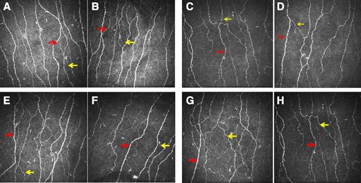 Figure 1. Corneal confocal images from control subject at baseline (A), control subject at follow-up (B), IGT subject who developed type 2 diabetes at baseline (C), IGT subject who developed type 2 diabetes at follow-up (D), IGT subject who remained IGT at baseline (E), IGT subject who remained IGT at follow-up (F), IGT subject who reverted to NGT at baseline (G), and IGT subject who reverted to NGT at follow-up (H). Red arrow, corneal nerve fiber; yellow arrow, corneal nerve branch.