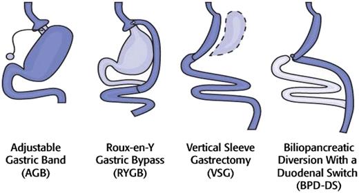 Figure 5. Bariatric surgical options. Image courtesy of Walter Pories, MD (East Carolina University, Greenville, NC).