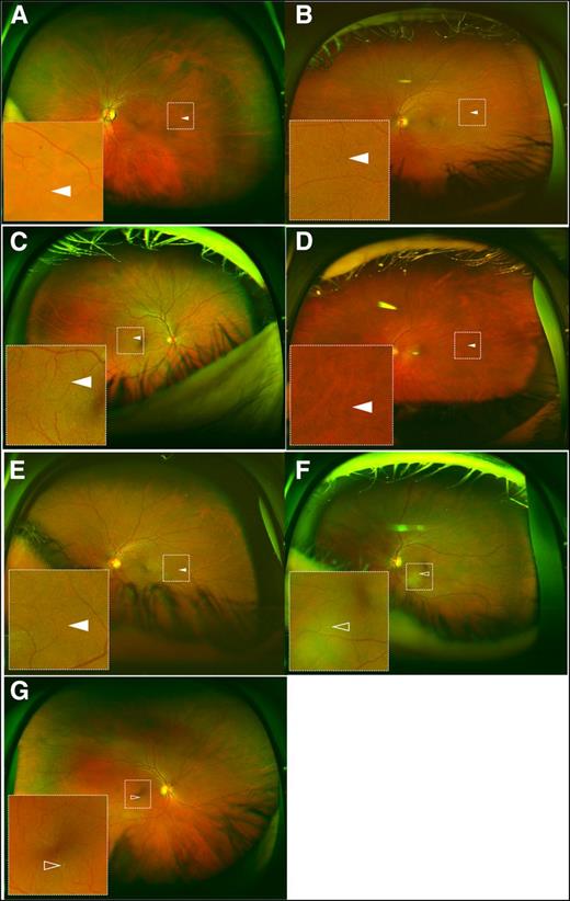 Figure 1. Images from all seven eyes with false-negative point-of-care results for referable DR (defined as reading center evidence of moderate NPDR or worse or any level of DME) compared with standard masked reading center evaluation. Each ultrawide field image is inlaid with a corresponding magnified section of the boxed area showing the missed lesion. Solid arrowheads indicate IRMA and open arrowheads indicate hard exudates within 1,500 μm of the foveal center. A–E: Eyes with moderate NPDR due to IRMA less than ETDRS standard photograph 8A. F and G: Eyes with hard exudates less than ETDRS standard photograph 3.