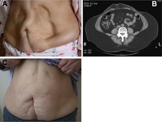 Figure 1. A: Marked and ice cube tray–shaped insulin lipoatrophy throughout the whole abdomen in a subject with type 2 diabetes. B: Very severe loss of adipose tissue in the entire abdomen is shown with computerized tomography. C: Photograph of patient′s abdomen after the recovery of insulin lipoatrophy.