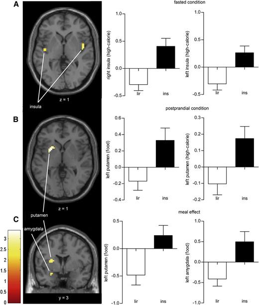 Figure 3. Differences in CNS activation between liraglutide and insulin glargine after 10 days of treatment. Axial slices showing average differences in activation in brain regions where liraglutide decreases CNS activation after 10 days of treatment compared with insulin glargine in obese patients with type 2 diabetes (n = 20) in response to the viewing of high-calorie food pictures (high-calorie food > nonfood) in the fasted condition (A) and after viewing food pictures (food > nonfood) in the postprandial condition (B), including the bar charts for the effect of food pictures and high-calorie food pictures. C: A coronal slice with areas where treatment with liraglutide, compared with insulin, enhanced the reducing effect of the standardized meal intake on CNS activation in response to the viewing of food pictures (food > nonfood). The left side of the axial and coronal slices is the left side of the brain. The color scale reflects the T value of the functional activity. Results are presented at the threshold of P < 0.05, family-wise error corrected on cluster extent. In the graphs, BOLD signal intensity (effect size) is plotted (arbitrary unites), mean and SEM. BOLD, blood oxygen level–dependent; ins, insulin glargine; lir, liraglutide.