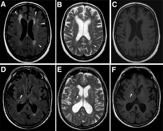 Figure 1. Magnetic resonance images illustrating WMLs and lacunar infarcts in two different patients. Arrowheads show examples of WMLs and lacunar infarct. Fluid-attenuated inversion recovery (FLAIR) (A), T2-weighted (B), and T1-weighted (C) images of the same patient: WMLs in the frontal and parieto-occipital areas are seen on FLAIR and T2-weighted images. FLAIR (D), T2-weighted (E), and T1-weighted (F) images of another patient: a right thalamic lacunar infarct is seen hypointense on T1-weighted image (F), hyperintense on T2-weighted, and hypointense with marginal hyperintensity on the FLAIR image.