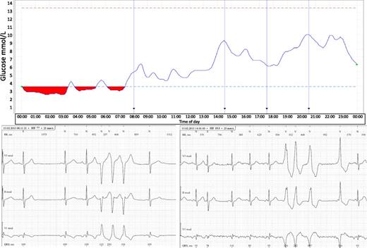 Figure 1. Case report: male 63 years old with documented stenosis of the internal cerebral artery, diabetes duration 12 years, and treatment with 22 IU insulin glargine at bedtime: parallel recording of continuous glucose monitoring system and Holter.