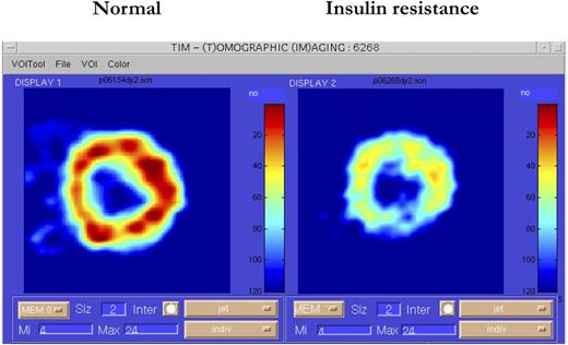 Figure 3. The use of a glucose analog (18F-deoxyglucose) and positron emission tomography images of the left ventricular wall of the heart of a normal subjects (left). The diffuse pattern of tracer uptake documents the absence of perfusion defects; quantification of these images measures insulin-mediated glucose uptake. In the insulin-resistant subject (right), tracer uptake is also diffuse but uniformly reduced, thereby demonstrating myocardial insulin resistance.