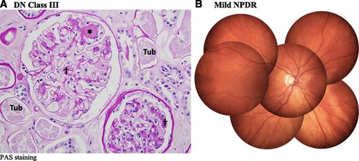 Figure 2. Kidney (A) and retinal (B) photographs of a 72-year old Medalist patient with 66 years of type 1 diabetes and severe diabetic nephropathy (DN class III), but only mild DR (nonproliferative DR [NPDR]), and no CVD, showing differential protection. PAS, periodic acid-Schiff staining; Tub, tubule. *Kimmelstiel-Wilson nodule. †Mesangial expansion.