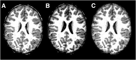 Figure 1. Brain images for case study subject at three time points. A: Age 6.5 years; antecedent mild hypoglycemia (63 mg/dL) prior to scan showing small ventricles and faint sulci. B: Age 8.0 years; hyperglycemic (324 mg/dL) prior to scan with large ventricles and wide sulci. C: Age 11.8 years; glucose level 169 mg/dL prior to scan. Images are T1-weighted MRI scans at 1 × 1 × 1 mm resolution.