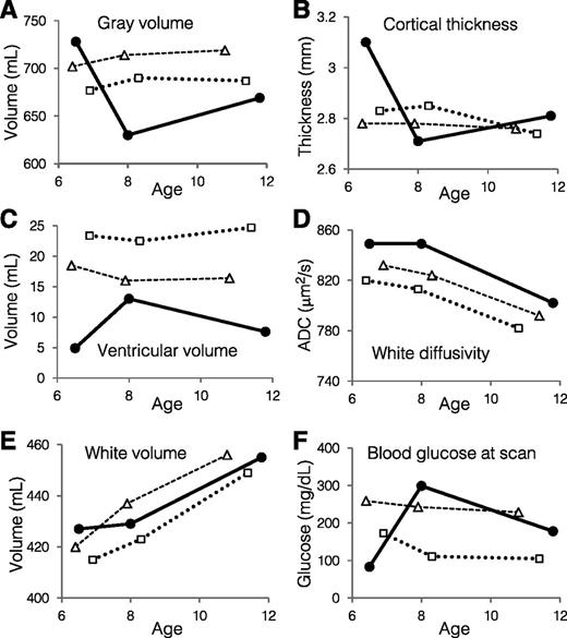 Figure 2. Brain structural and diffusivity characteristics and blood glucose measured at three ages. A: Total gray matter volume. B: Cortical mean thickness. C: Volume of lateral ventricles. D: Apparent diffusivity coefficient (ADC) averaged for all cerebral white matter. E: Total white matter volume. F: Blood glucose immediately before MRI scan. Black circles = case study subject. For comparison, growth trajectories are shown of two other male children with diabetes whose blood glucose at scan was similar across all time points (white squares, glucose 105–170 mg/dL at times of scans; white triangles, glucose 230–260 mg/dL at times of scans). These graphs suggest that the volume changes seen in the case study subject were due to short-term glycemic effects rather than long-term hyperglycemia.