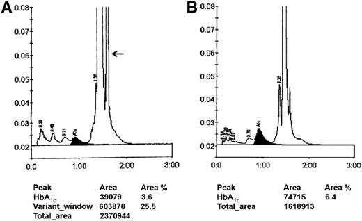Figure 1. Chromatograms of HbA1c tests. A: HPLC chromatogram of the proband. Arrow indicates the abnormal peak. The HbA1c measured was 3.6% (16 mmol/mol). B: HPLC chromatogram of the husband of the proband as normal control. The HbA1c measured was 6.4% (47 mmol/mol).
