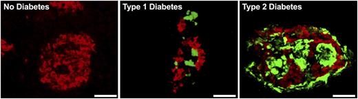 Figure 1. Representative pancreatic islets from a healthy individual and individuals with type 1 diabetes and type 2 diabetes. Islet amyloid is demonstrated by thioflavin S staining (green) and β-cells by insulin immunostaining (red). Scale bar = 50 µm.