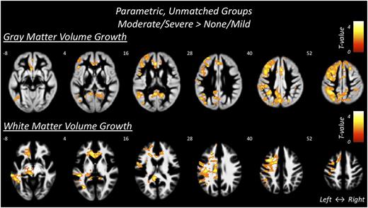 Figure 1. VBM regions of increased volume growth. Gray and white matter regions where participants with a history of moderate/severe DKA compared with those who experienced none/mild DKA had more growth (T18 − Tb) in GMV and WMV. Color map represents the statistical significance of growth differences between groups.