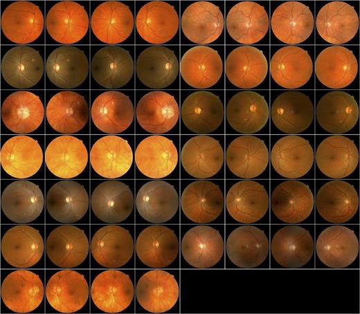 Figure 3. Right and left eye images (two images per eye, with one disc and one fovea centered) of the 13 participants who were false negative for the mtmDR output of the device, according to the ICDR reference standard. None had vtDR or macular edema. The vtDR output did not have any false negatives.