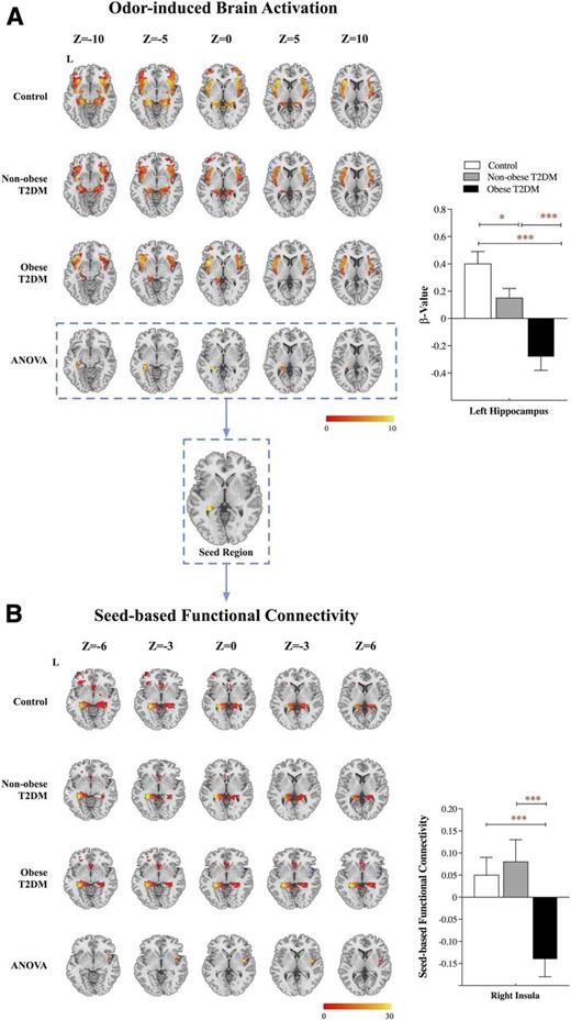 Figure 1. Odor-induced brain activation and seed-based functional connectivity among control subjects (n = 35) and nonobese (n = 35) and obese (n = 35) subjects with type 2 diabetes (T2DM) adjusted for covariates of age, education, BMI, and vascular risk factors. ANCOVA indicated significantly decreased odor-induced brain activation in obese subjects with diabetes compared with nonobese subjects with diabetes and control subjects (cluster size threshold: 14 voxels), specifically in the left hippocampus. These regions showing significant difference among three groups were taken as seed regions for functional connectivity analysis (A). Significantly decreased functional connectivity with right insula was demonstrated in obese subjects with diabetes compared with nonobese subjects with diabetes and control subjects (with GRF correction, voxel level P < 0.001, cluster level P < 0.05, and cluster size threshold 23 voxels) (B). *P < 0.05 and ***P < 0.001 were considered significant. L, left.