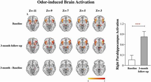 Figure 3. Odor-induced brain activation in obese patients with diabetes treated with GLP-1Ras for 3 months (n = 19). Paired t tests demonstrated significantly increased odor-induced brain activation in obese diabetes (with GRF correction, voxel level P < 0.001, cluster level P < 0.05, cluster size threshold 13 voxels), specifically in right parahippocampus. ***P < 0.001 was considered significant. L, left.