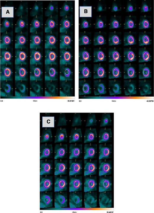 Figure 2. PET Images related to global myocardial MRGlu in the subjects with NGT 1-h low (A), NGT 1-h high (B), and IGT (C).