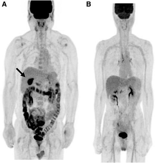 Figure 1. Representative [18F]FDG PET images of subjects in the metformin (A) and control (B) groups. The arrow indicates gallbladder cancer, the primary illness of this patient.