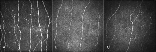 Figure 1. CCM images of the central cornea in a healthy control subject (A), an age-matched patient with type 2 diabetes (B), and an age-matched patient with type 1 diabetes (C).