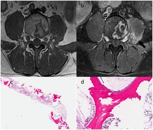 Figure 1. a: Axial T1-weighted image shows a serpiginous line with low T1 signal within the vertebral body. There is a decrease in size of the left psoas muscle with a subtle increase in T1 signal compared with right. b: Axial T1-weighted image post-contrast shows serpiginous enhancement within the vertebral body, in keeping with a vertebral infarct. There is enhancement of the left proximal lumbosacral plexus (arrow), in keeping with an acute lumbosacral plexitis. There is diffuse enhancement of the left psoas and iliac muscles, which is suggestive of acute denervation atrophy. c: At low power, the core biopsy shows viable and nonviable bony spicules with focal marrow fat necrosis and occasional hematopoietic elements (magnification ×2, hematoxylin and eosin [H&E] stain). d: At higher power, there are nonviable fragments of lamellar bone with empty lacunae (lacking osteocytes). Along one edge (superior aspect), there is immature woven bone being laid down on top of the nonviable bone (an “osteoid seam”) by osteoblasts, representing bone remodeling in the setting of osteonecrosis (magnification ×20, H&E stain).