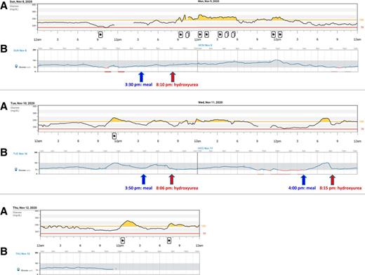 Figure 1. Simultaneous CGM tracings obtained on the Dexcom G6 system (A) and the Abbott FreeStyle Libre system (B). Blue arrows indicate the meal 4 h prior to hydroxyurea administration on the test days, and red arrows indicate hydroxyurea administration in the fasting state on the test days.