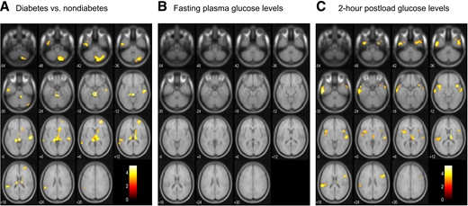 Gray matter regions that were inversely correlated with the presence of diabetes (A), FPG levels (B), and 2hPG levels (C). The regions of gray matter atrophy associated with diabetes mainly involved the bilateral superior temporal gyri, right middle temporal gyrus, left inferior temporal gyrus, right middle frontal gyrus, bilateral thalami, right caudate, and right cerebellum (A). There were no significantly decreased gray matter areas that were correlated with higher FPG levels (B). Those associated with elevated 2hPG levels included the bilateral superior, middle, and inferior gyri, bilateral temporal poles, bilateral insulae, left parietal operculum, right opercular part of the inferior frontal gyrus, and right thalamus (C). Values were adjusted for age, sex, low education, hypertension, serum total cholesterol, BMI, smoking habits, alcohol intake, regular exercise, cerebrovascular lesions on MRI, ICV, and/or antidiabetic mediation.