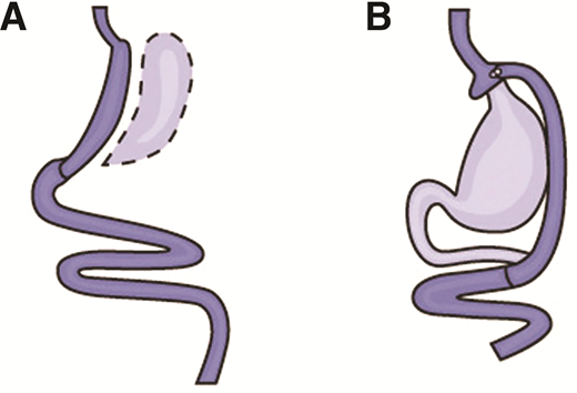 A: Vertical sleeve gastrectomy. B: Roux-en-Y gastric bypass surgery. Images reprinted from National Institute of Diabetes and Digestive and Kidney Diseases (141).