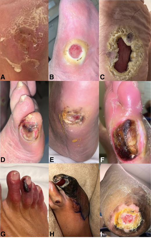 Characteristic examples of preulcerative (A), neuropathic (B and C), neuroischemic (D–F), and ischemic (H–I) DFU.