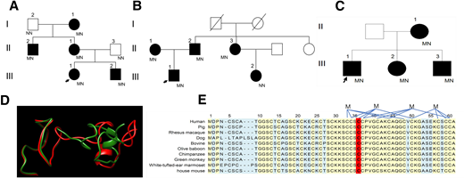 Pedigrees of three families and protein sequences. A–C: Pedigrees of families 1 (A), 2 (B), and 3 (C) are presented. Circles indicate female family members, and squares indicate male family members. Slashes indicate that the family member has died. Family members with diabetes are indicated by solid symbols, and those without diabetes are indicated by open symbols. Index patients (patients III-1) are indicated by arrows. Fetal genotypes NM (heterozygous MT1E variant) and NN (normal MT1E) are indicated. D: Protein structures of MT1E p.C36C (green) and p.C36Y (red) were predicted by AlphaFold. E: Protein sequences from different species are also presented, with the 36th amino acid highlighted in red, and cysteine binding sites for metal ions (M) on the α domain of the peptide are marked.