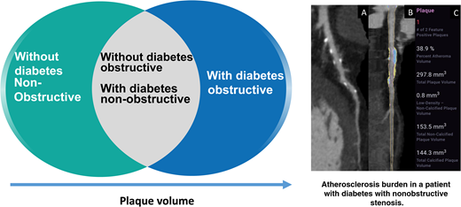 Left: Patients with diabetes with nonobstructive stenosis were associated with similar adverse plaque characteristics and PV as patients without diabetes with obstructive stenosis by AI-guided CCTA. Right: A 66-year-old patient with diabetes with CCTA undergoing AI-aided evaluation of stenosis and quantitative atherosclerosis burden. The patient demonstrates left anterior descending mild stenosis of 44% with a vessel-specific burden of plaque (297.8 mm3) consisting of both calcified (144.3 mm3) and noncalcified (153.5 mm3) plaque. The atheroma volume is 38.9%. In this patient, overall PV was 848.3 mm3 with overall atheroma volume of 17.8% and atheroma volume of CP of 8.6%. A: Shows a CCTA curved multiplanar reformat with plaque identified. B: Shows a straight reformat with a color overlay of NCP (yellow) and CP (blue). C: Shows a graphical output of the quantified PV by AI-aided evaluation.