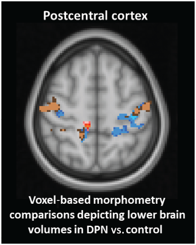 Brain alterations in key somatosensory and nociceptive regions in DPN.