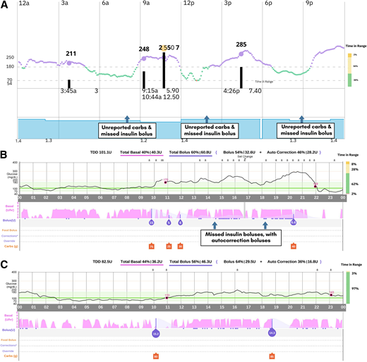 Daily summary reports of continuous glucose monitor, insulin delivery and events from three different periods. A: A typical day, showing elevated glucose levels, unreported carbohydrate (carb) intake, and late and missed insulin doses for both meals and correction. B: Improved glycemic metrics, despite missed insulin doses after the switch to MiniMed 780G. C: Virtually perfect TIR, secondary to calibration based on false glucose reading. TDD, total daily dose; U, units.