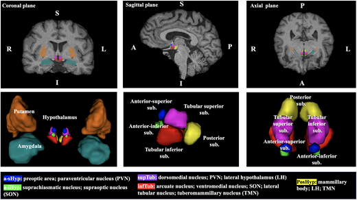 Hypothalamus location in the brain and specific subunits. A, anterior; I, inferior; L, left; P, posterior; R, right; S, superior.