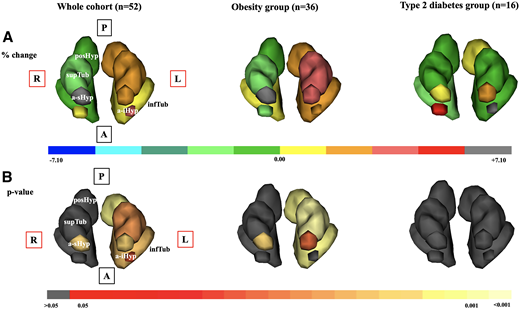 Percent volumetric hypothalamic changes (A) and their statistical significance (B) across hypothalamic subunits following BS in the whole cohort and in the obese and type 2 diabetes groups. Volumetric changes were calculated as the percentage of initial volume minus the final volume (1 year post-BS) divided by the initial volume. In A, warm colors (yellow, orange, pink, and red) represent a volumetric decrease after surgery, and cold colors represent a volumetric increase. In B, the grey color indicates nonsignificant changes. A, anterior; L, left; P, posterior; R, right.