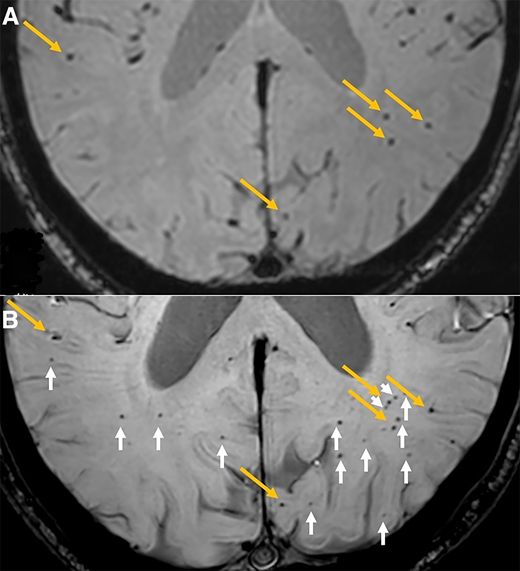 A: MRI scan from the baseline showing cerebral microbleeds (CMBs) identified in a single section, marked by yellow arrows. B: The same section as in the MRI scan from follow-up phase. Previously observed CMBs are marked by yellow arrows; new CMBs that appeared during the follow-up are indicated by white arrows.