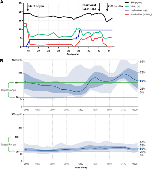 A: Timeline of BMI, HbA1c levels, and insulin and metreleptin doses. B: Continuous glucose monitoring ambulatory glucose profile report before and 1 year after transition from insulin to oral semaglutide.