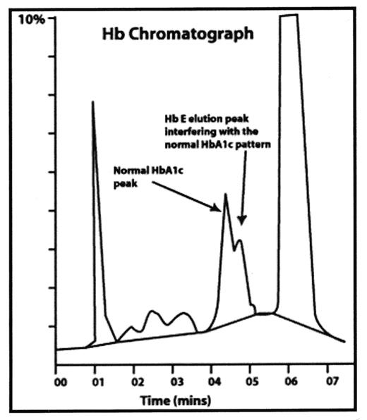 Figure 1. E pattern hemoglobinopathy interfering with the analysis of A1C value.