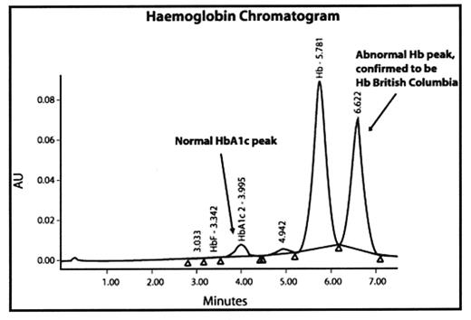 Figure 2. Abnormal peak of hemoglobin British Columbia on the hemoglobin chromatogram.