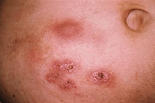 Figure 1. Pink nodules and pink, crusted, scaly papules coalescing into plaques on the right mid-abdomen.