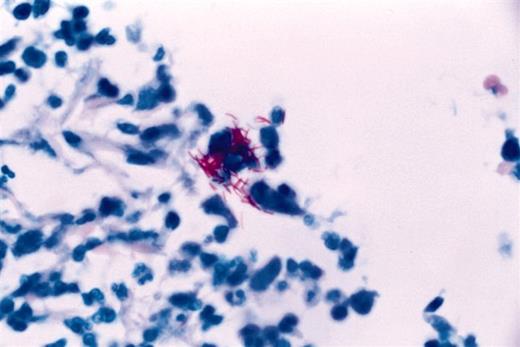 Figure 2. Multiple acid fast bacilli in the dermis (original magnification 100×)