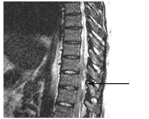 Figure 1. Epidural abscess precipitating DKA in a type 2 diabetic patient.