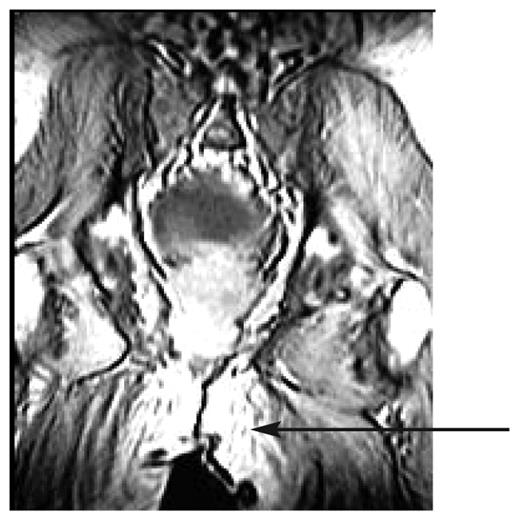 Figure 2. Prostatic abscess precipitating DKA in a type 2 diabetic patient.