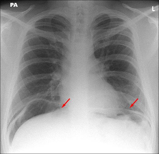 Figure 1. Chest X-ray showing air under diaphragm (arrows).