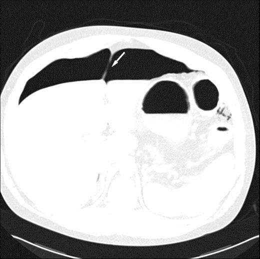 Figure 2. Abdominal CT scan showing presence of air within the peritoneal cavity. Arrow points to the falciparum ligament made prominent by the presence of air on both sides.