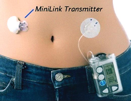 Figure 15. Glucose sensor