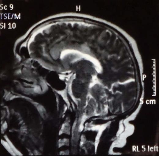 Figure 1. T2W MRI of the brain showing hyper-intense lesions in the rostrum, genu, and trunk of the corpus callosum, cingulate gyri, anterior parts of superior frontal gyri, precuneus, and paracentral lobules.