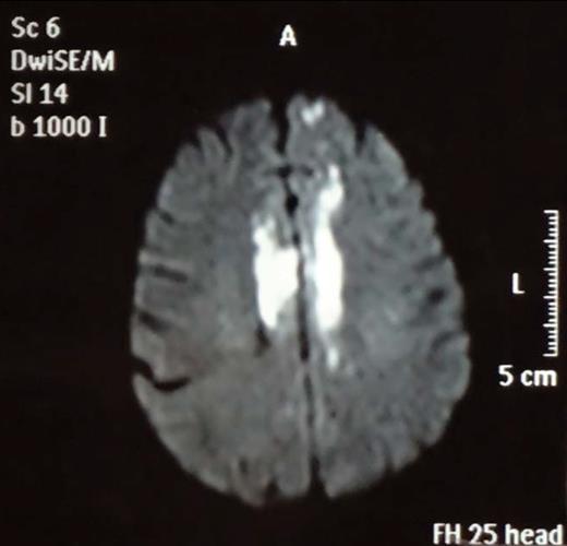 Figure 2. Diffusion-weighted imaging showing the lesions to be acute infarcts.